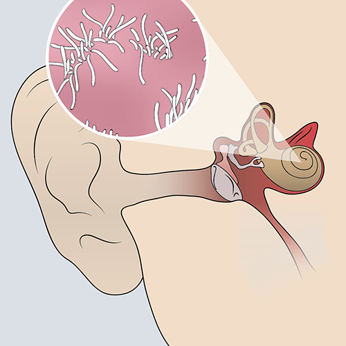 Sensorineural Hearing Loss